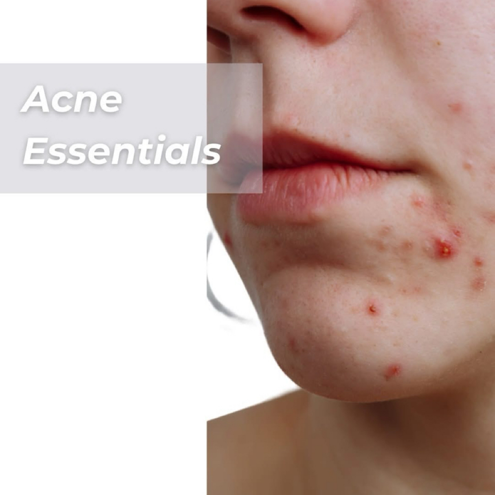 Acne Program Consult and Treatment at Holistic Skin Center in Edgewater, FL