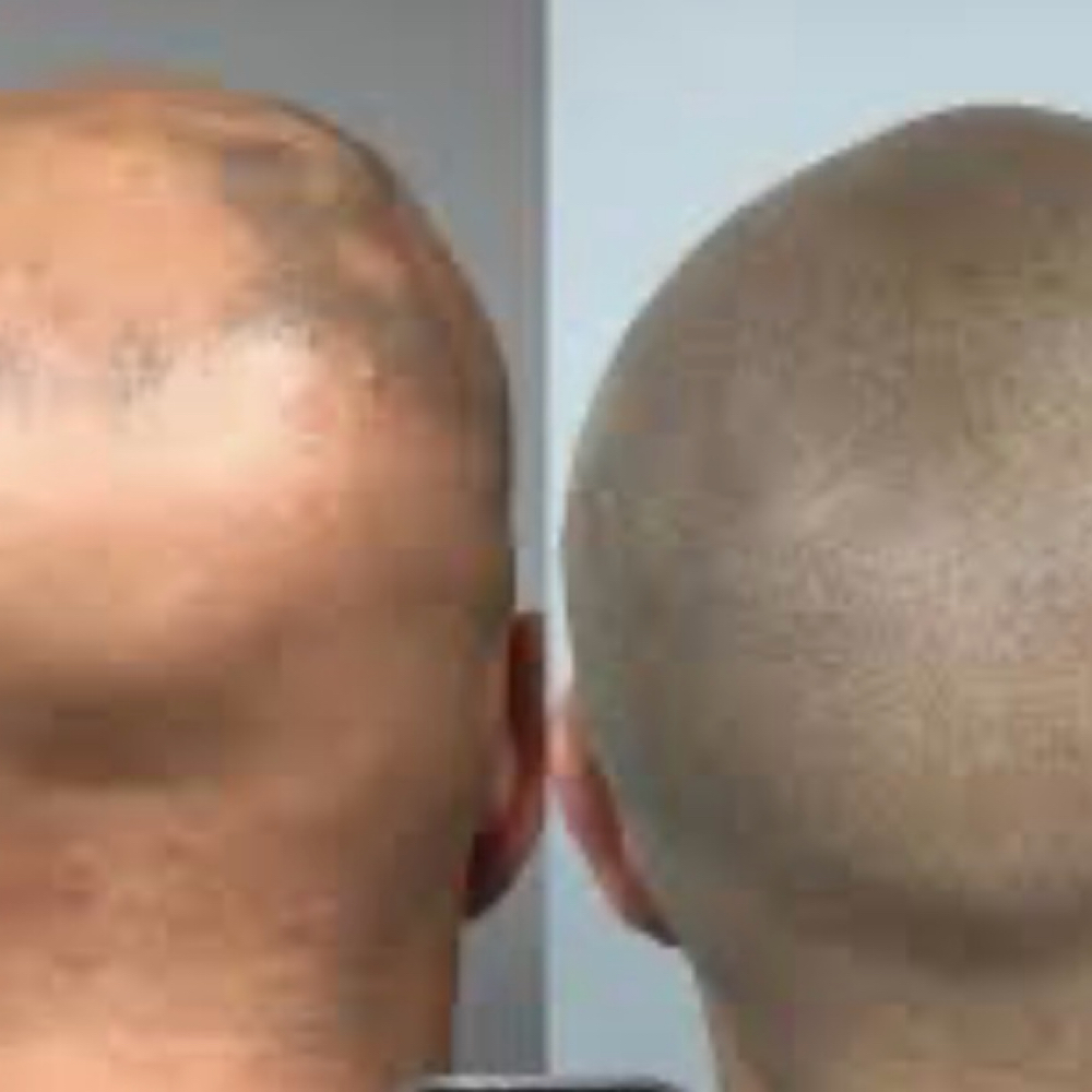 Full Head Pigment at Pure Clinical Skin in Goodyear, AZ