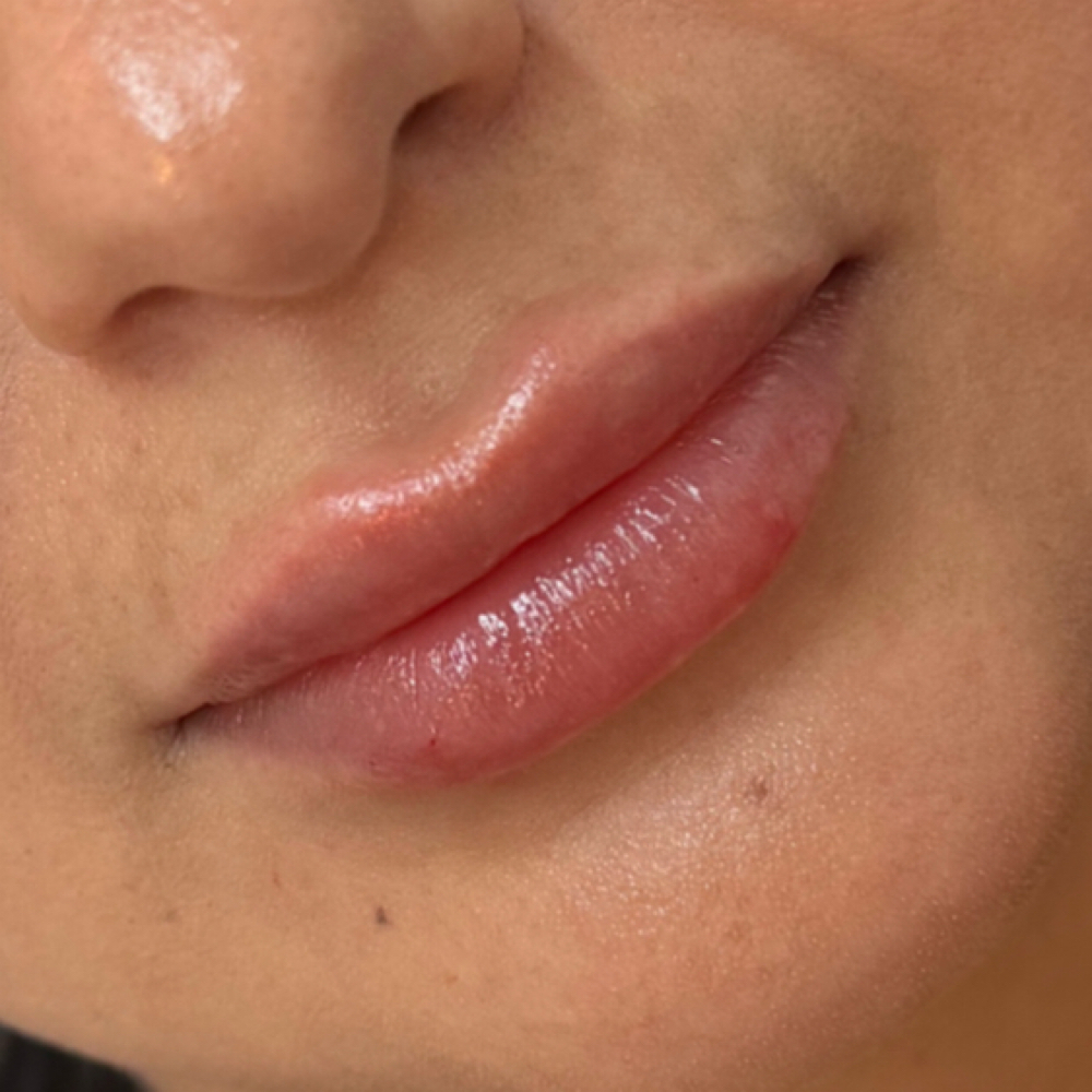 Half Syringe Versa Lips at Alt Boutique & Aesthetics | Nurse Injector in Hereford, TX