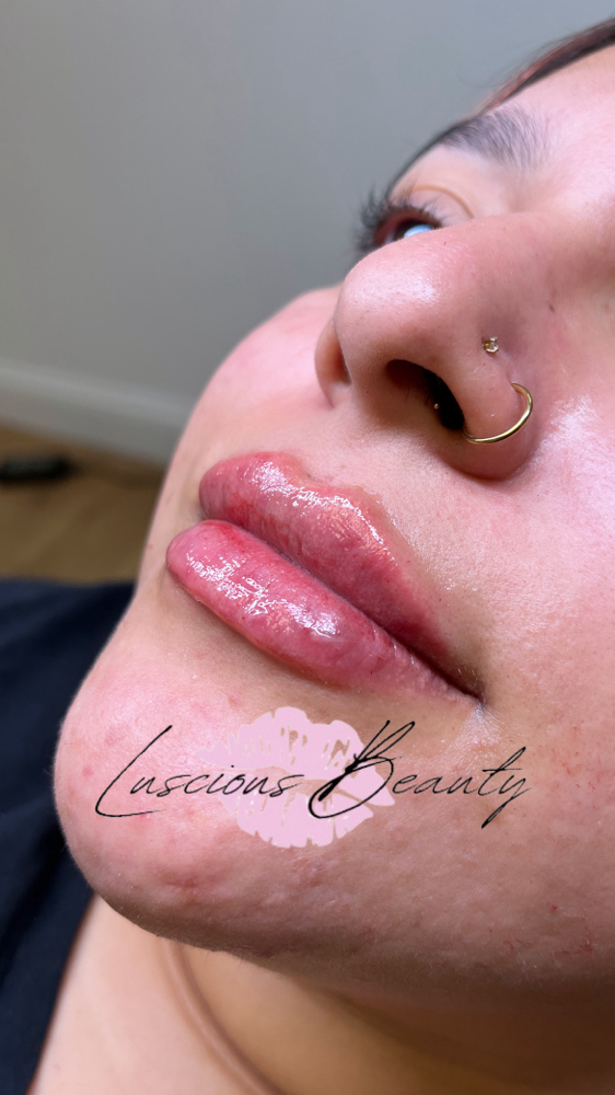 1ML HYALURONIC ACID LIP FILL