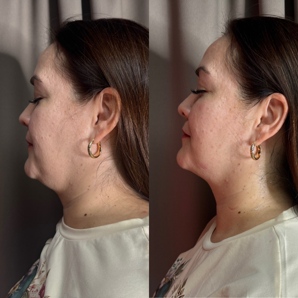 Face & Chin Contour (1 Session)