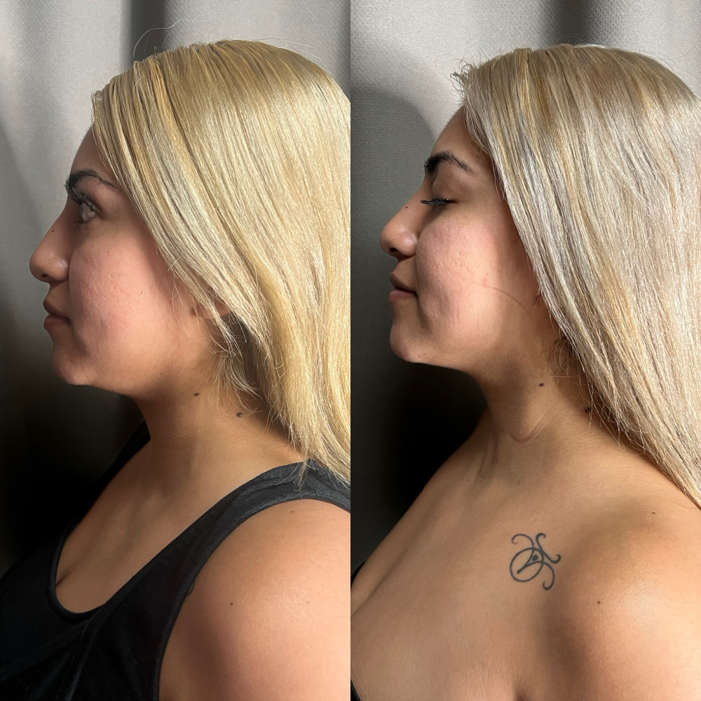 Face Contour (1 Session)