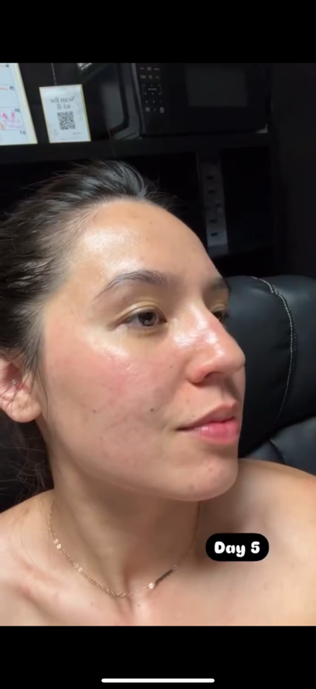 Facial Resurfacing
