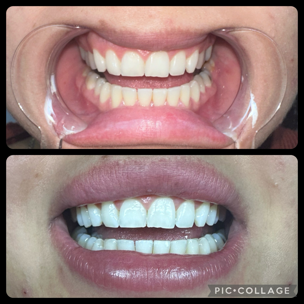 DaVinci Teeth Whitening at EmpowerHer Beauty in Zillah, WA