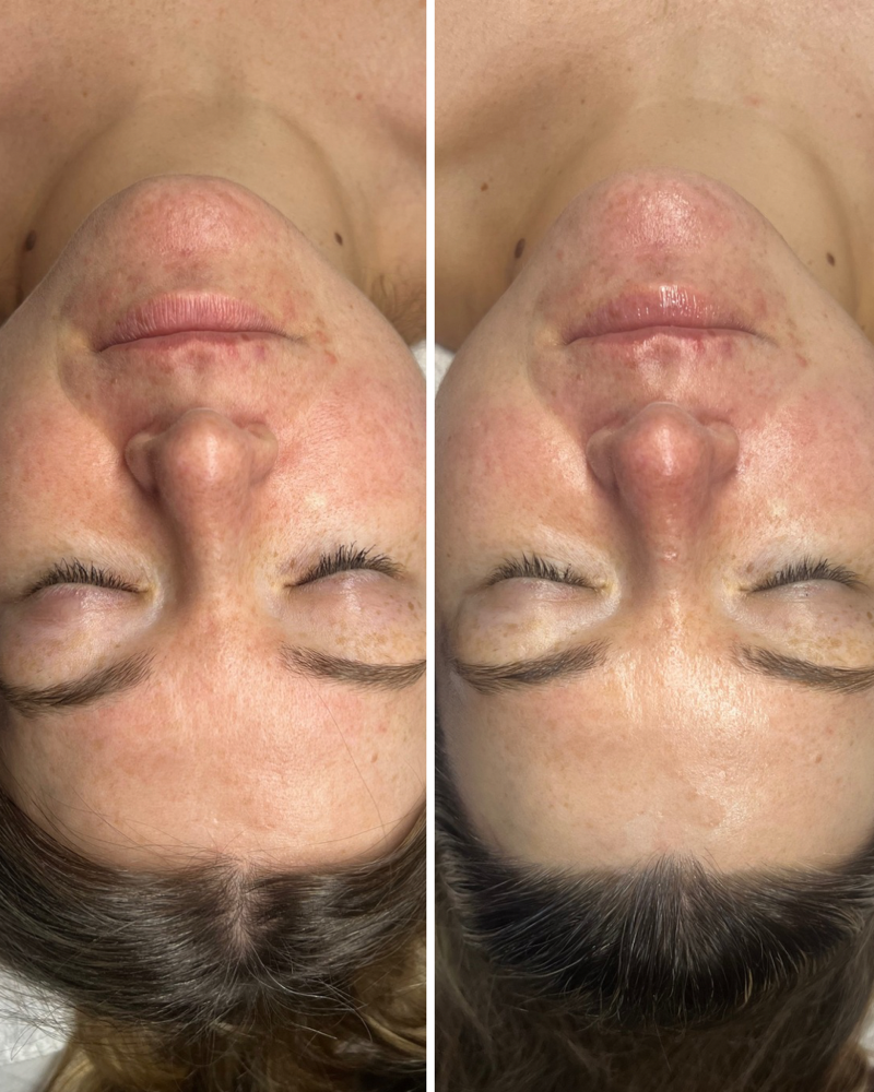 Oxygen RX treatment facial