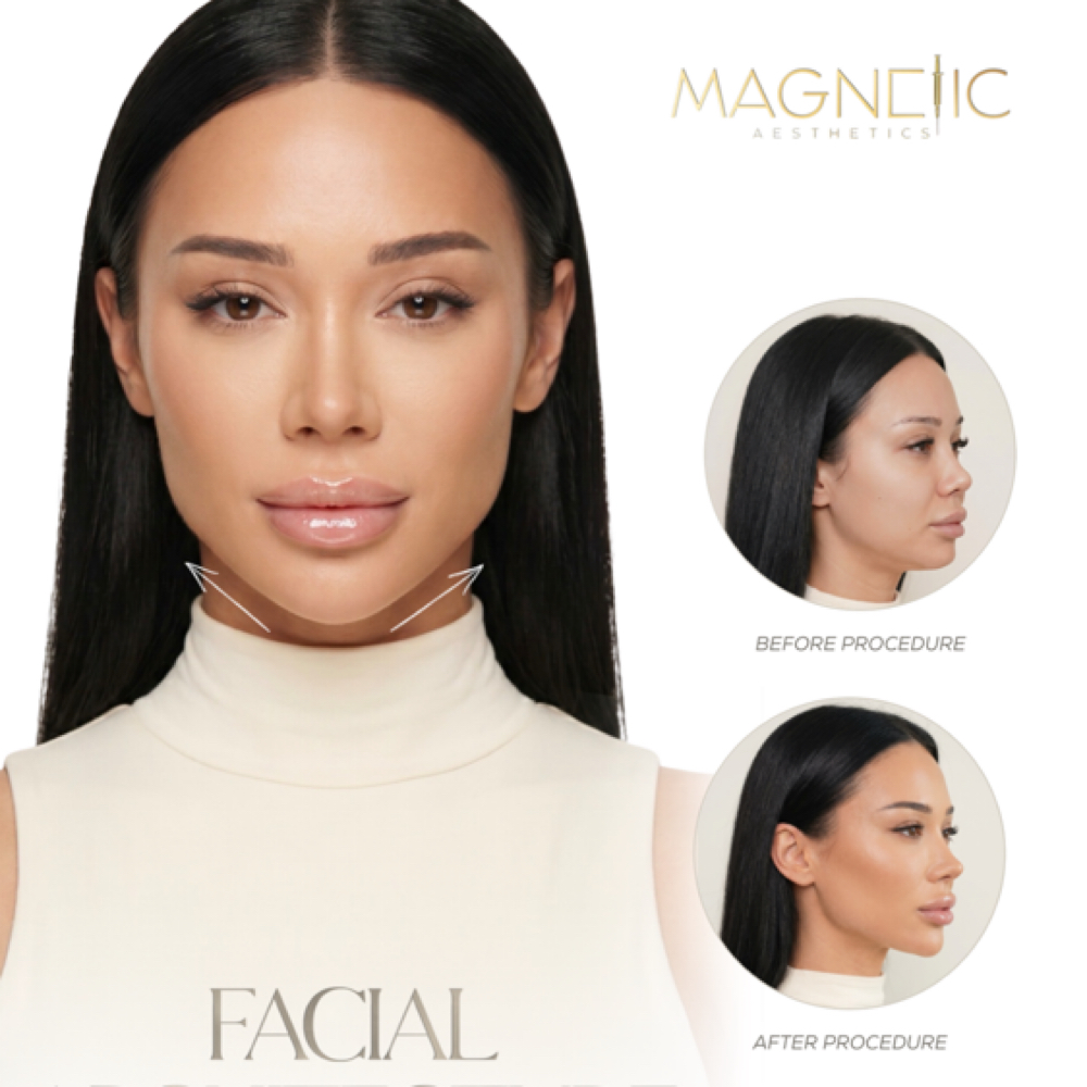 1 Syringe Of Facial Filler at Magnetic Aesthetics in Frisco, TX