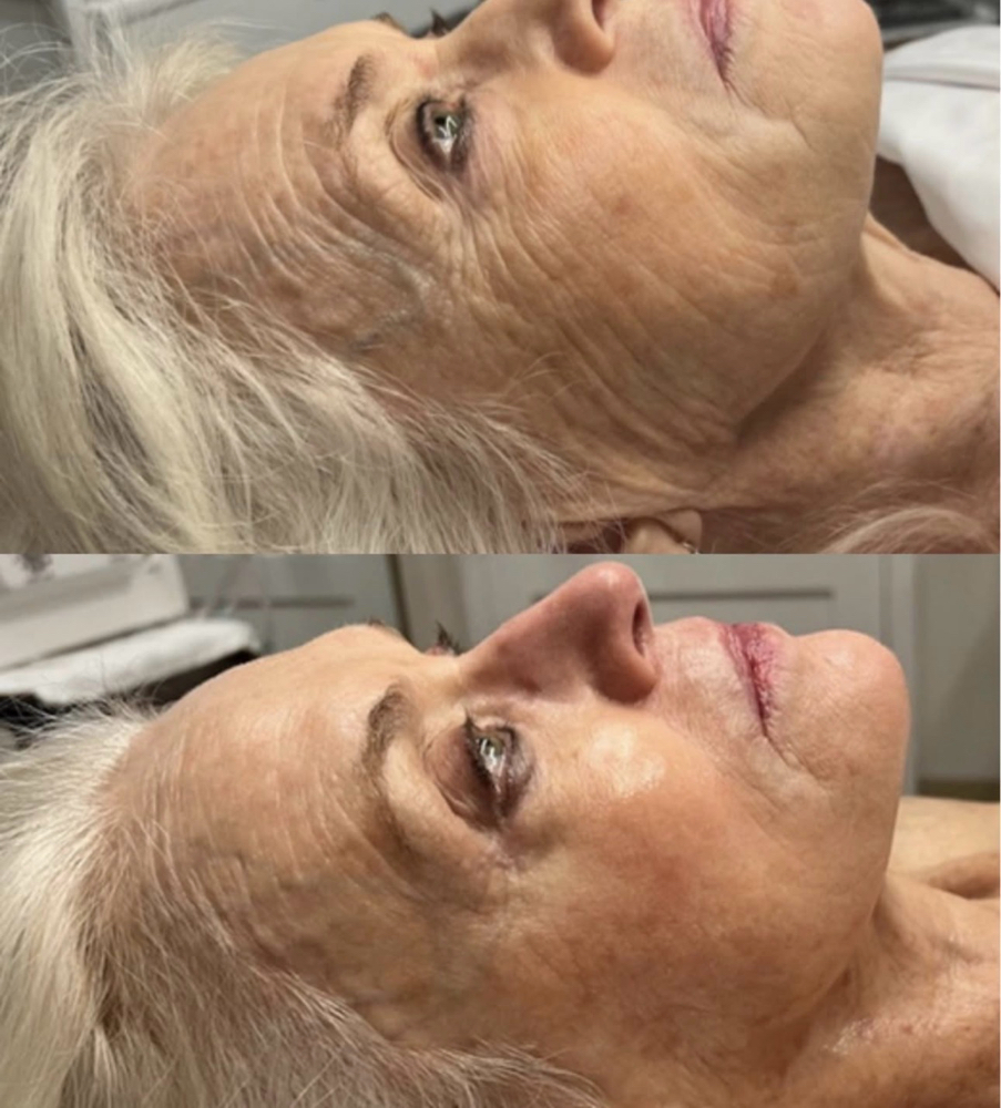 SWITCH Dermal Revitalization Facial