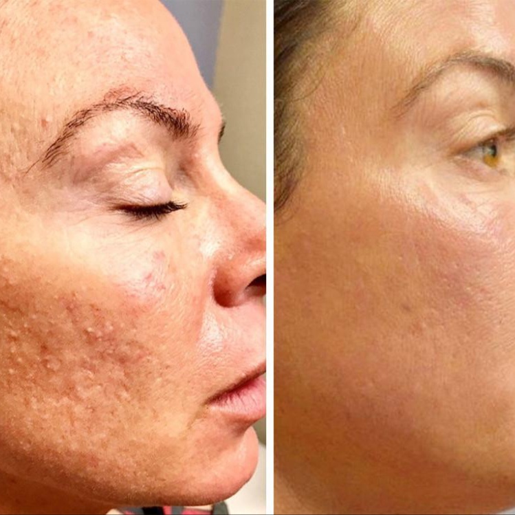 Acne Correction Bootcamp