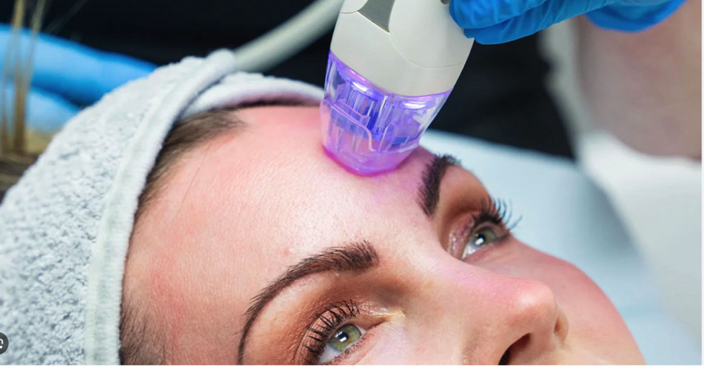 Radiofrequency Microneedling