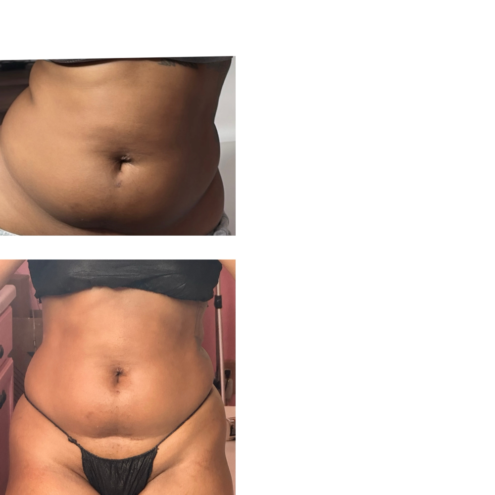 10 Treatments Stomach/back at Eygptian Esthetics in Upper Marlboro, MD