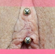 VCH (Vertical Clitoral Hood)