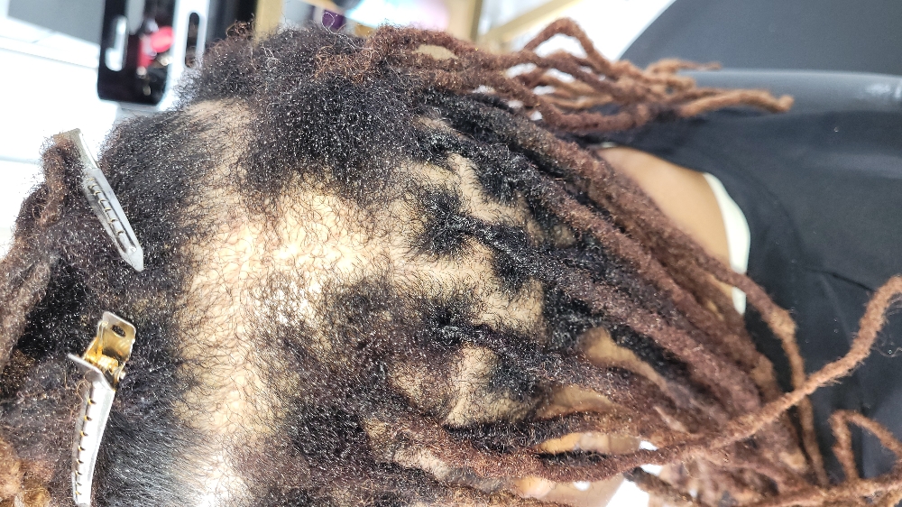 Consult: Scalp Disorder /Hair Loss