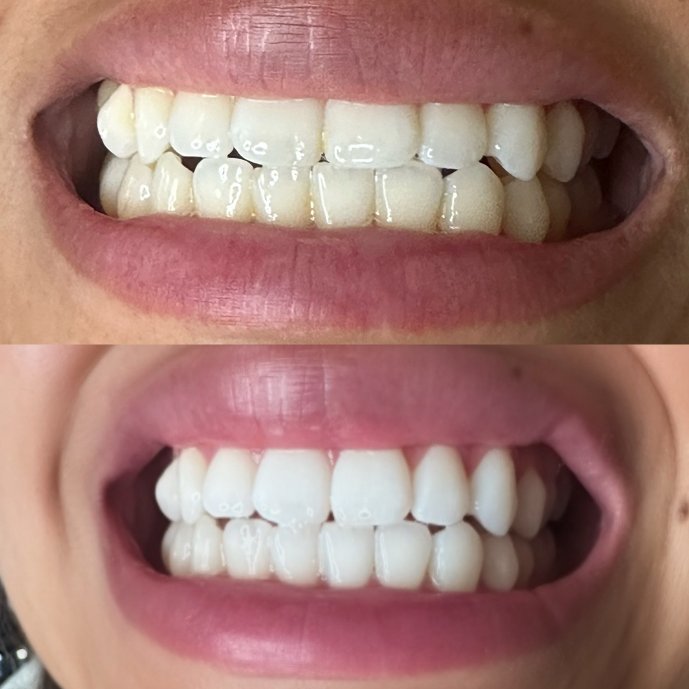 Teeth whitening at Beautiful Crazy in Redlands, CA