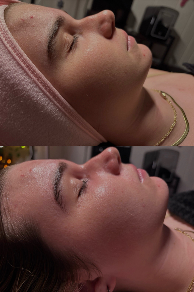 Teen Corrective Facial