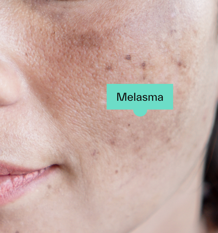 Melasma at Leidy Cornelio Spa in Aurora, CO