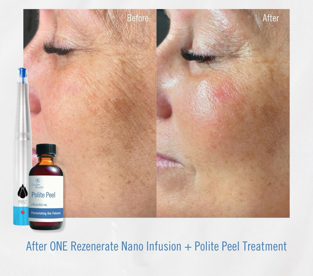 Rezenerate NanoFacial&Chemical Peel