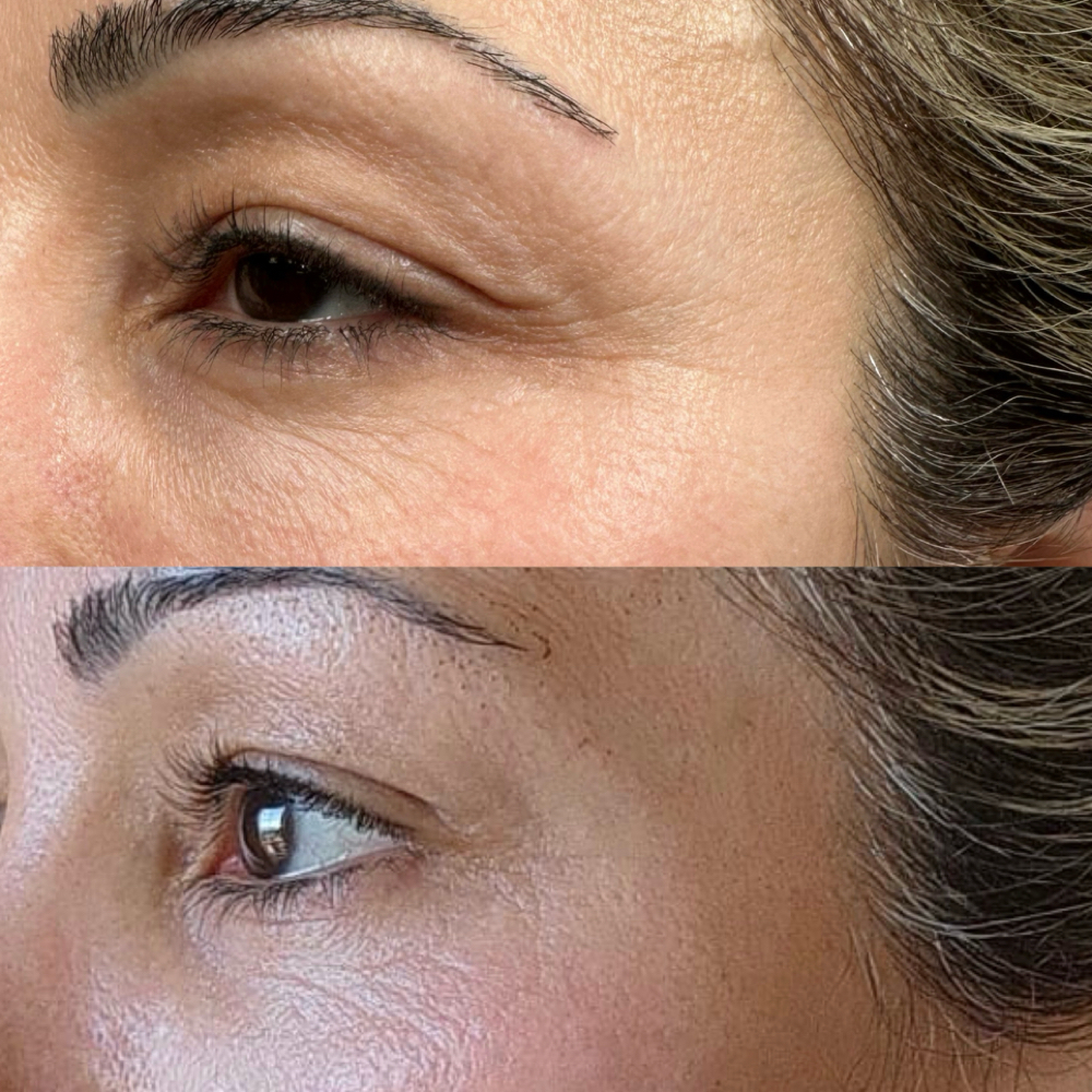 Panda Eyelift at Magnolia Plasma Fibroblasting By Mitra in Frisco, TX