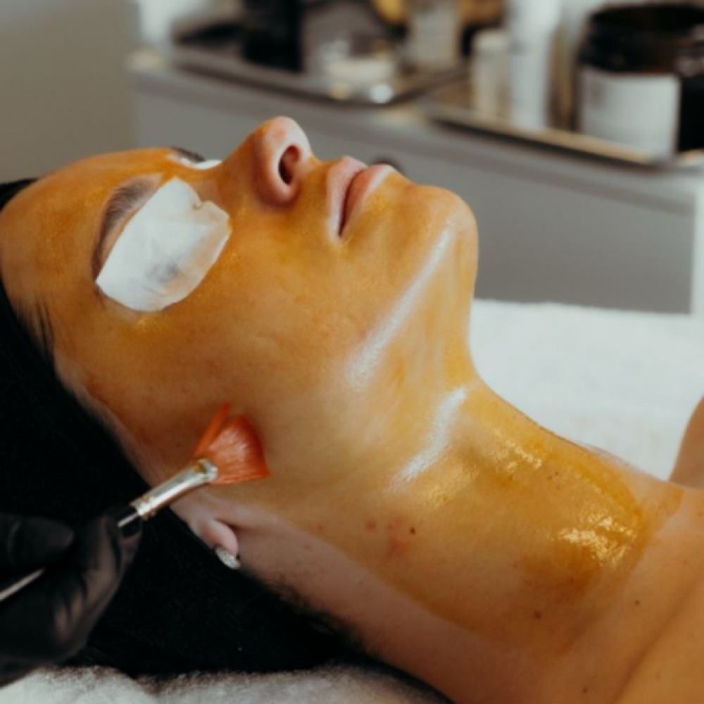 Chemical Peel