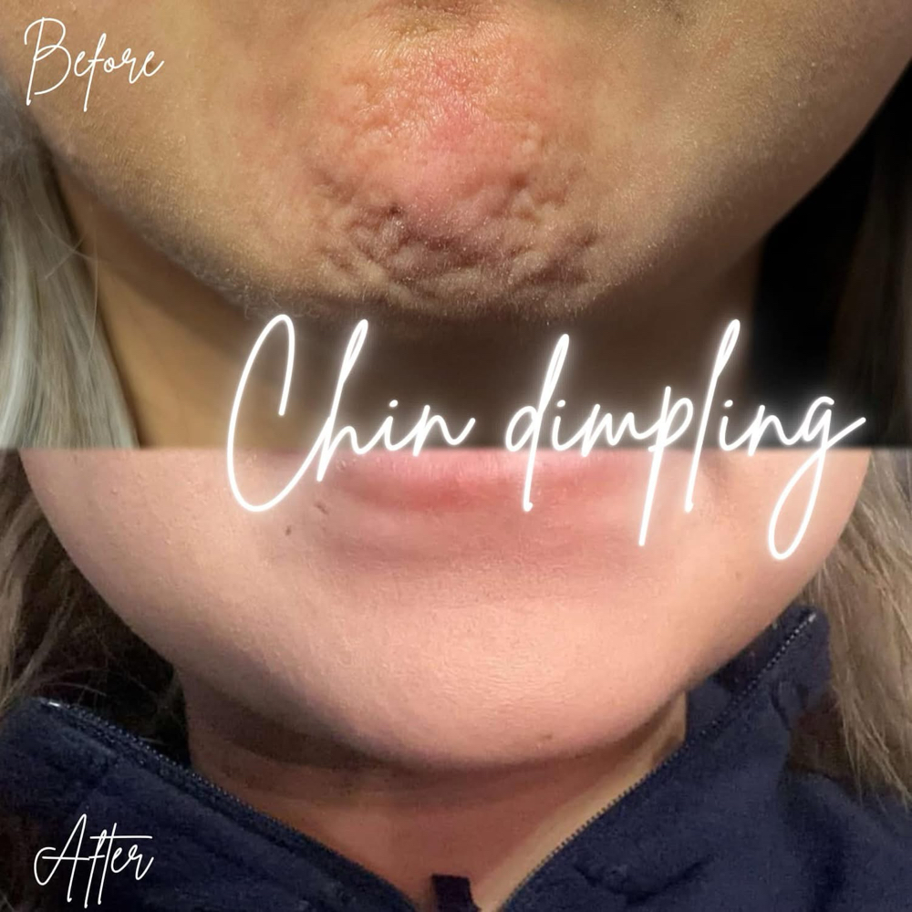 Tox-Chin Dimpling💉 at BeautyHolic Aesthetics LLC in Lubbock, TX