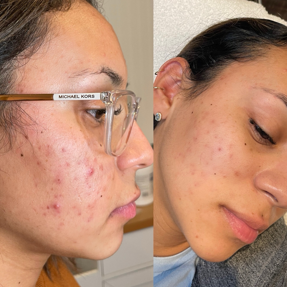 The Perfect Derma Peel