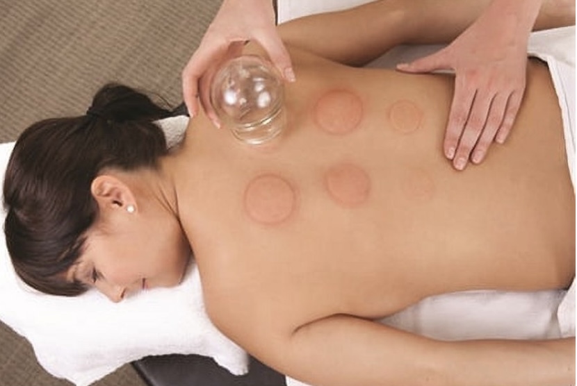Cupping Therapy