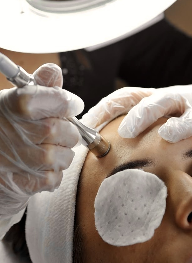 Microdermabrasión (extra)