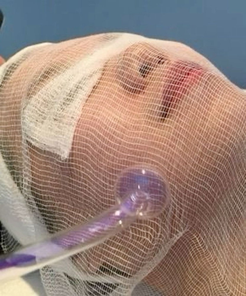 High Frequency Facial