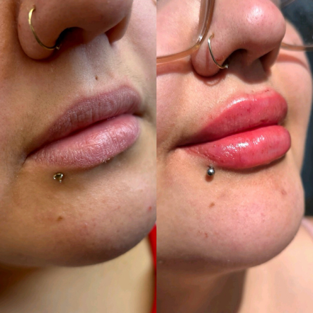 The Full Effect💋1 ML (Full) Filler at The Lavish Effect ✨️ Luxury Lashes, Lips & Brows in Lubbock, TX