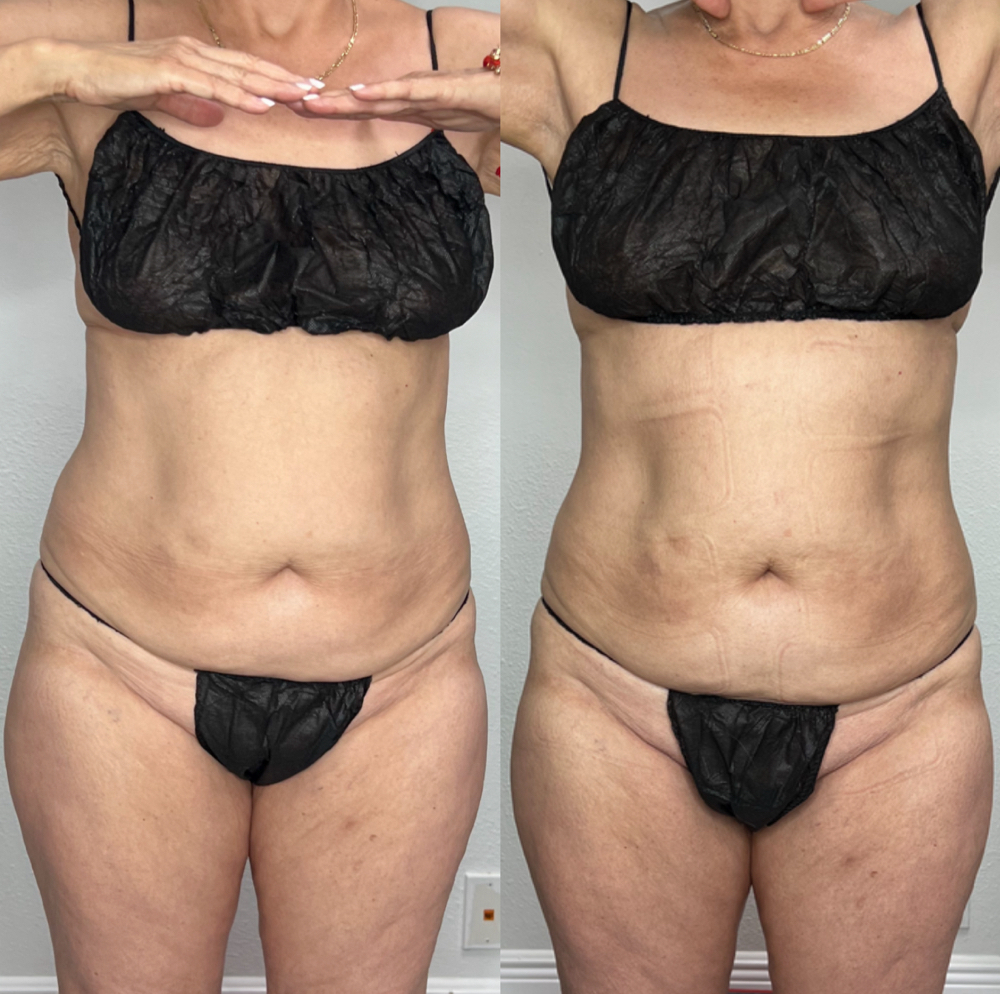 Tummy Transformation