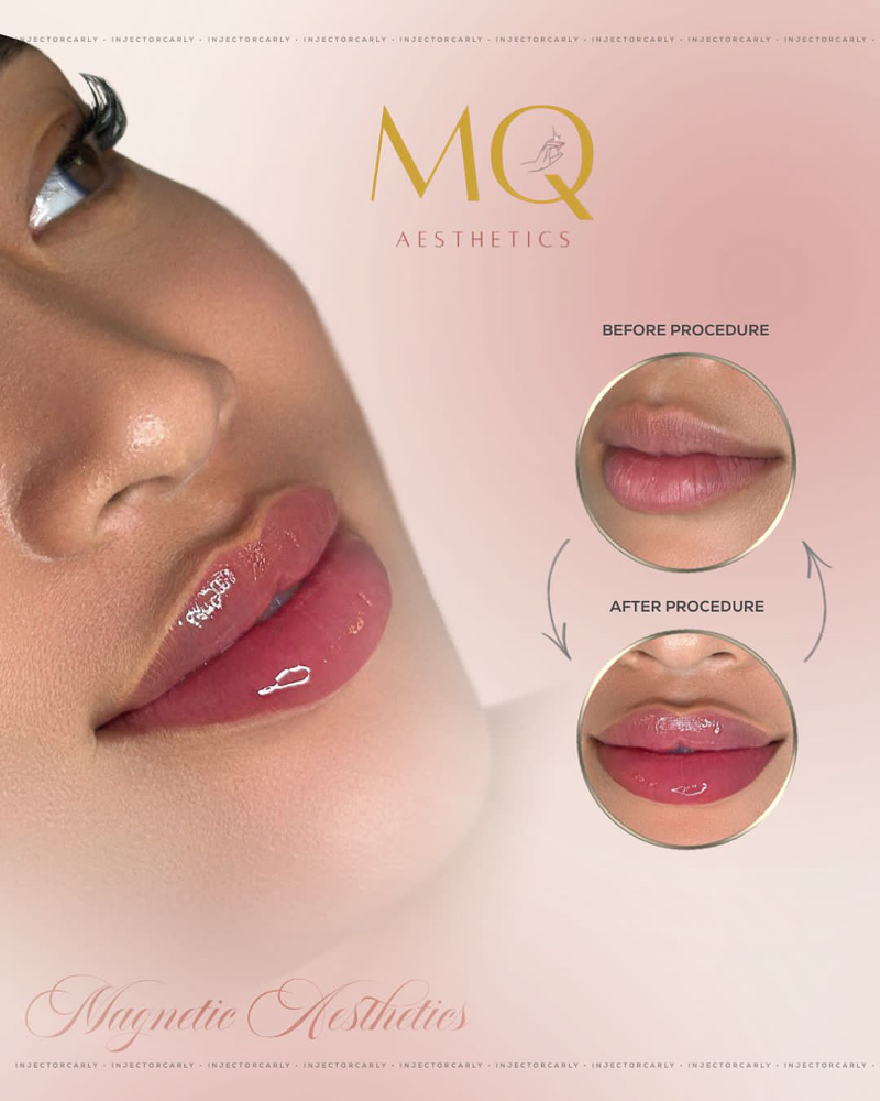 1ML Needle Lip Filler