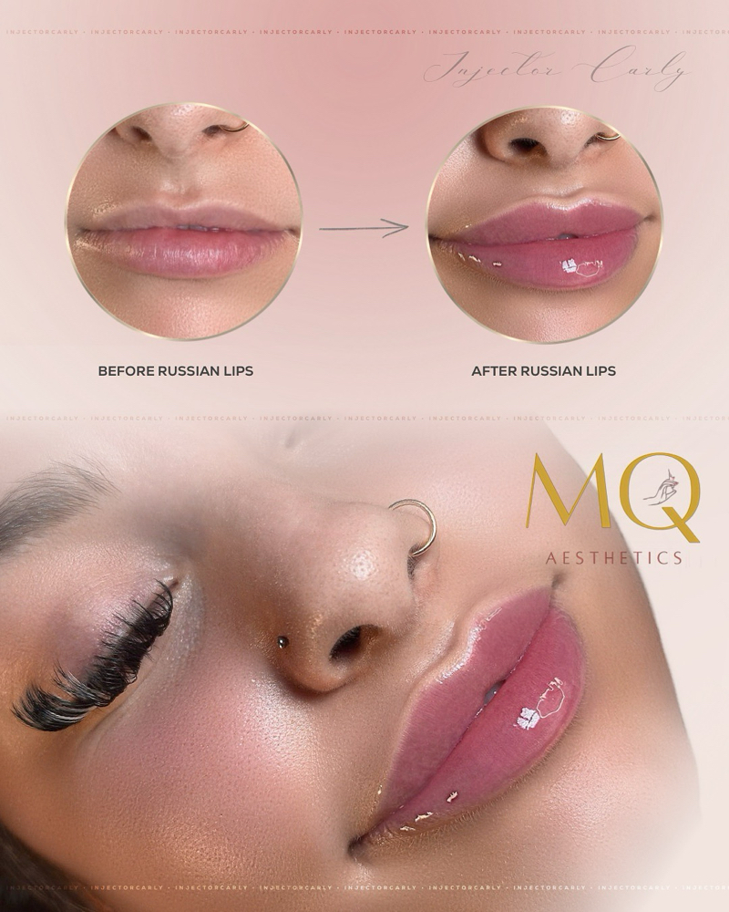 1ML Russian Technique Lip Filler