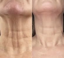 Skin Tightening  Face And Neck