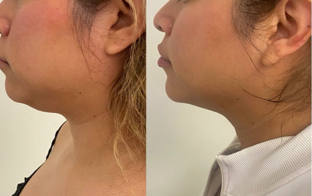 Kybella