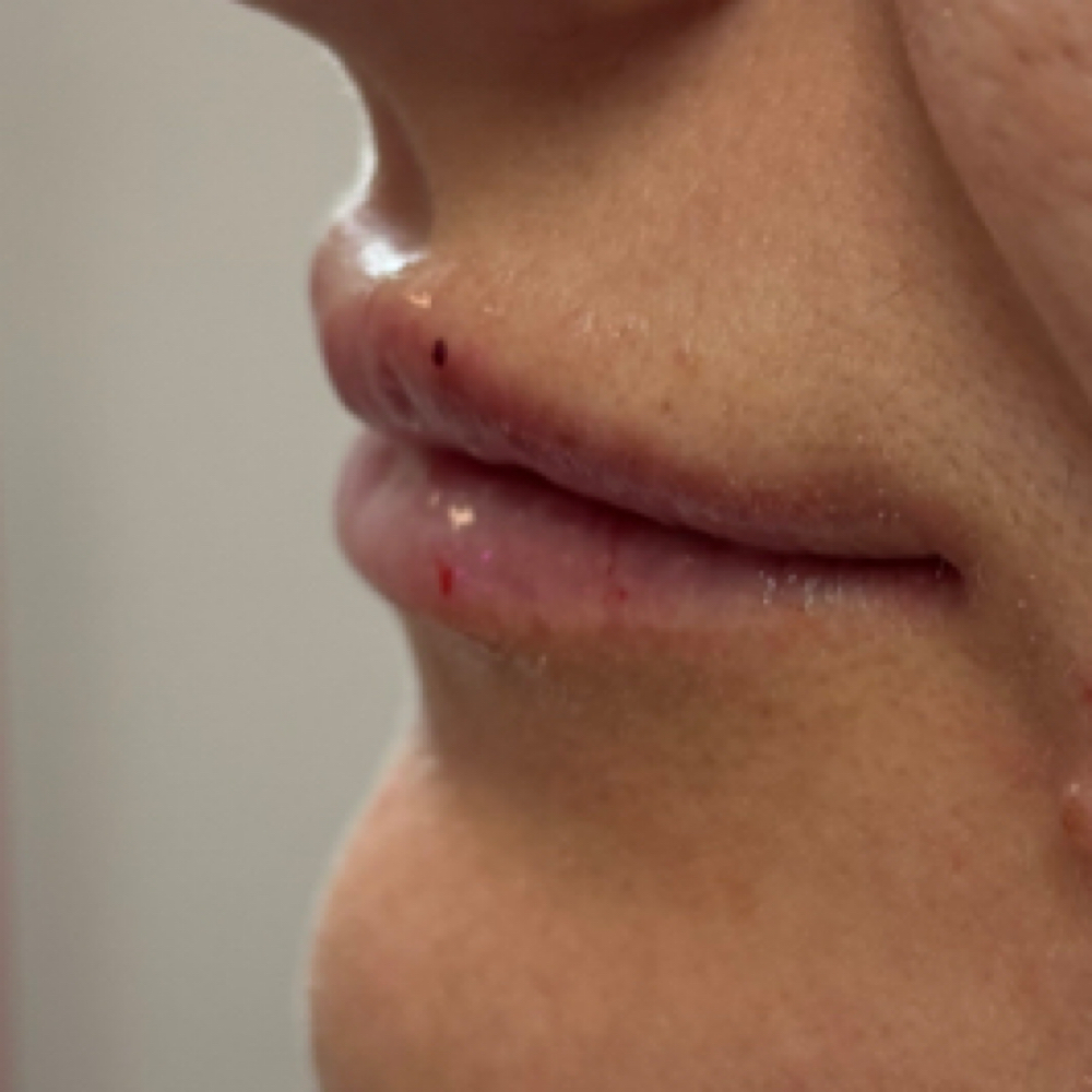 HA Filler Dissolving