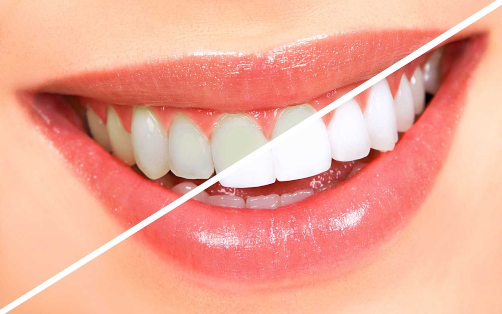 Flash Teeth Whitening