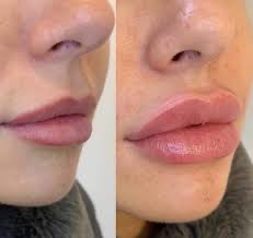 Lip Filler