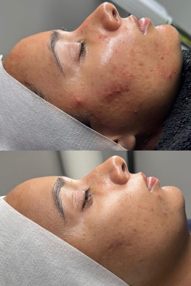 Peeling & Facial Profundo