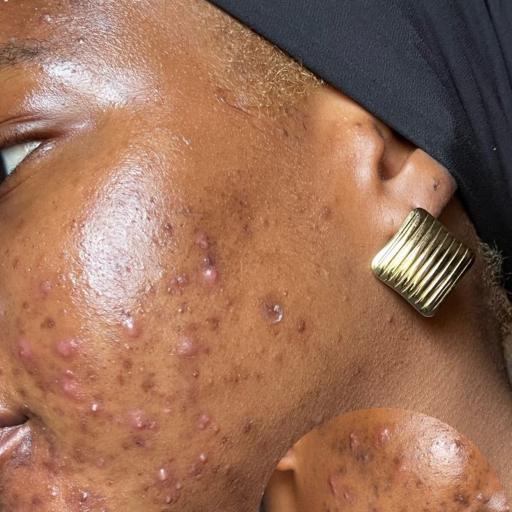Acne Treatment (Facial) at Luxe Royale Spa in Paramus, NJ