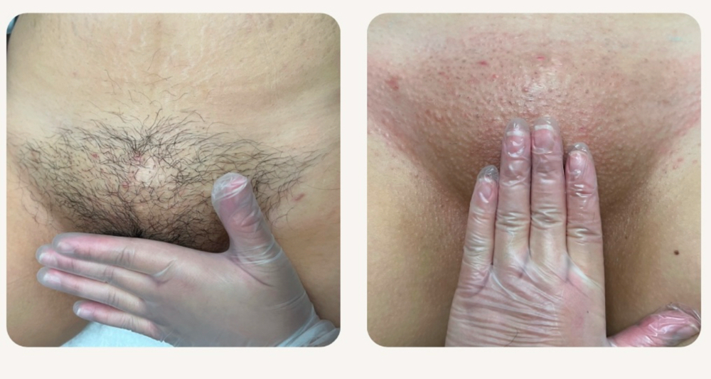 Brazilian Wax