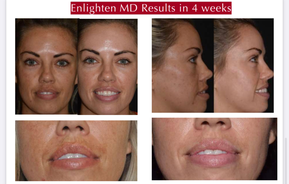 MD Enlighten Depigmentation Peel