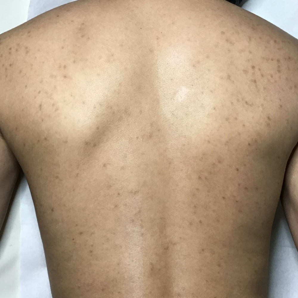 Backne Treatment at Acnessia Laser Clinic in Guaynabo, PR