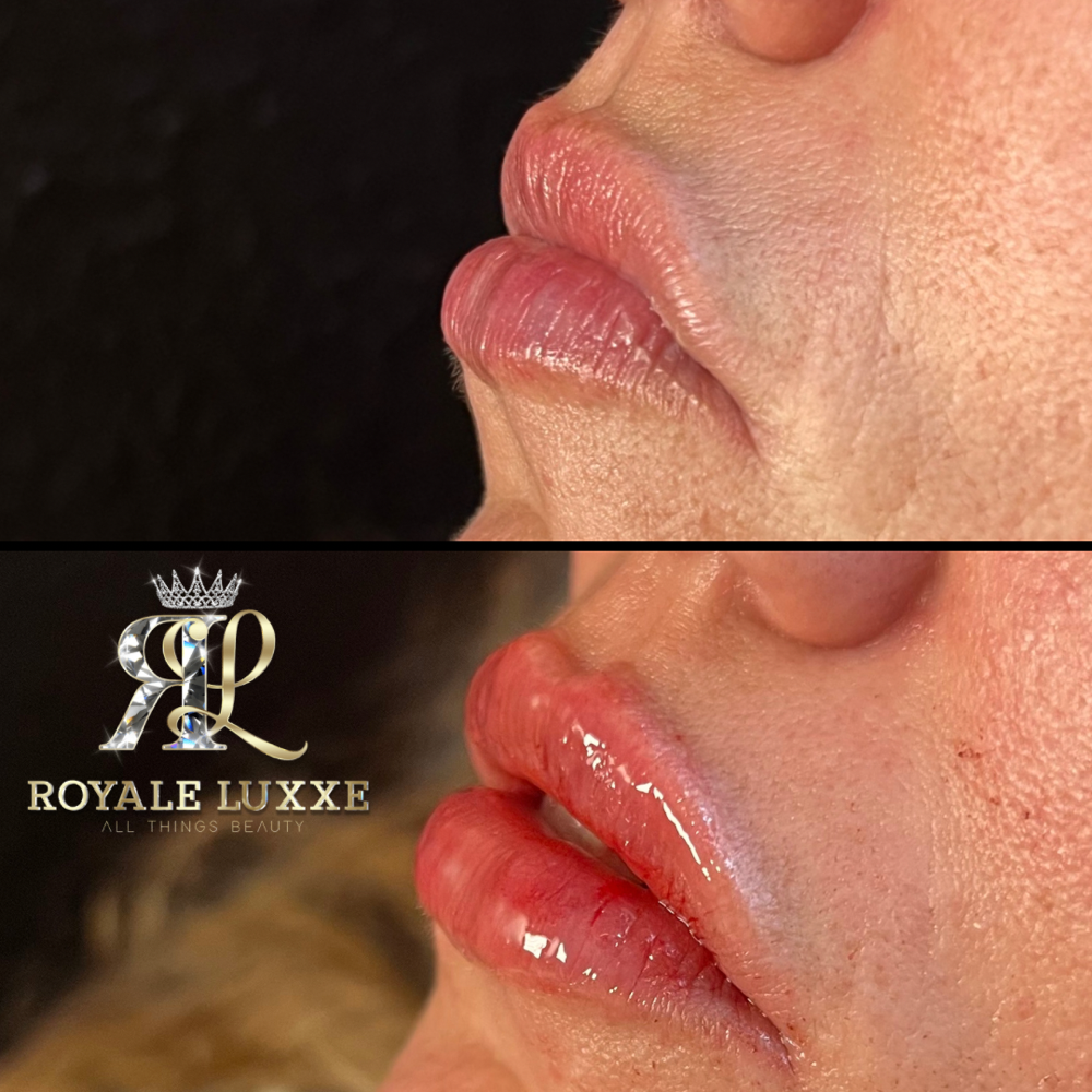 Hyaluron Lip Filler 1ML at Royal Luxxe Studios in Colleyville, TX