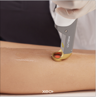 ND YAG Vein Therapy