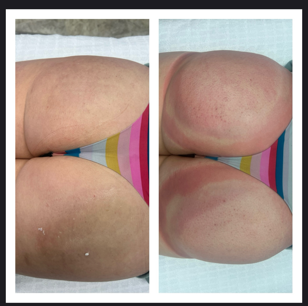 BBL (Brazilian Butt Lift)