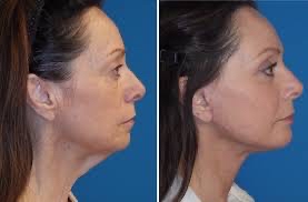5D Neck/Chin Laser Lipo - 6