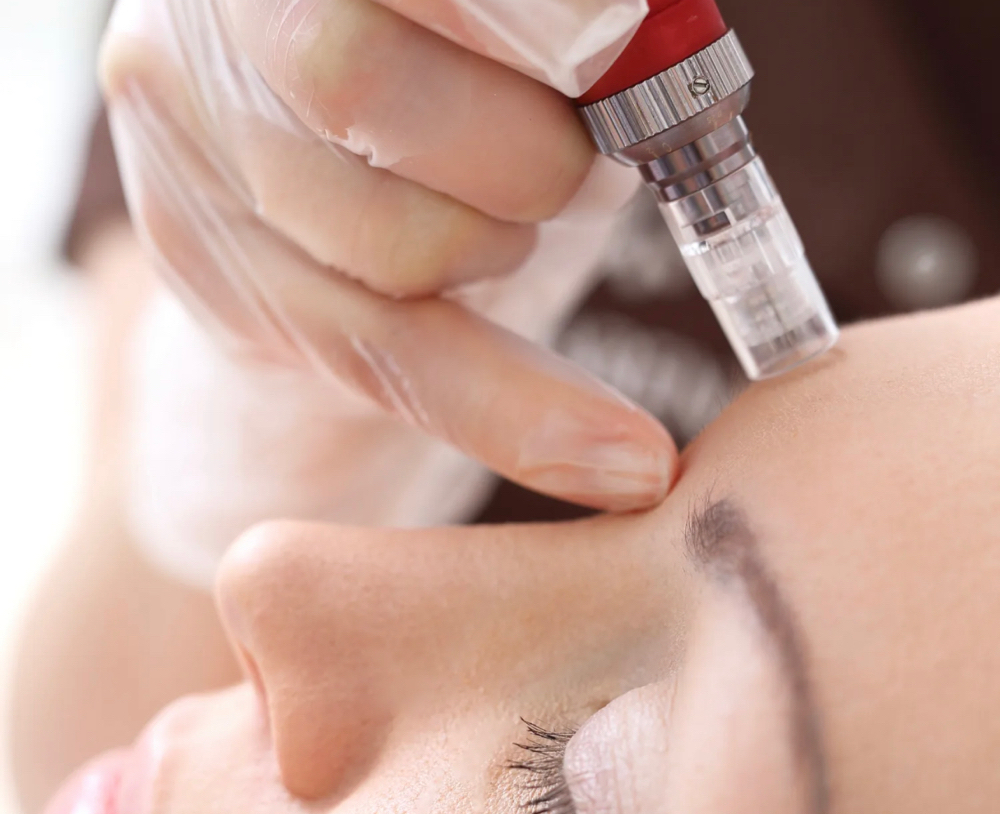 Micro Needles