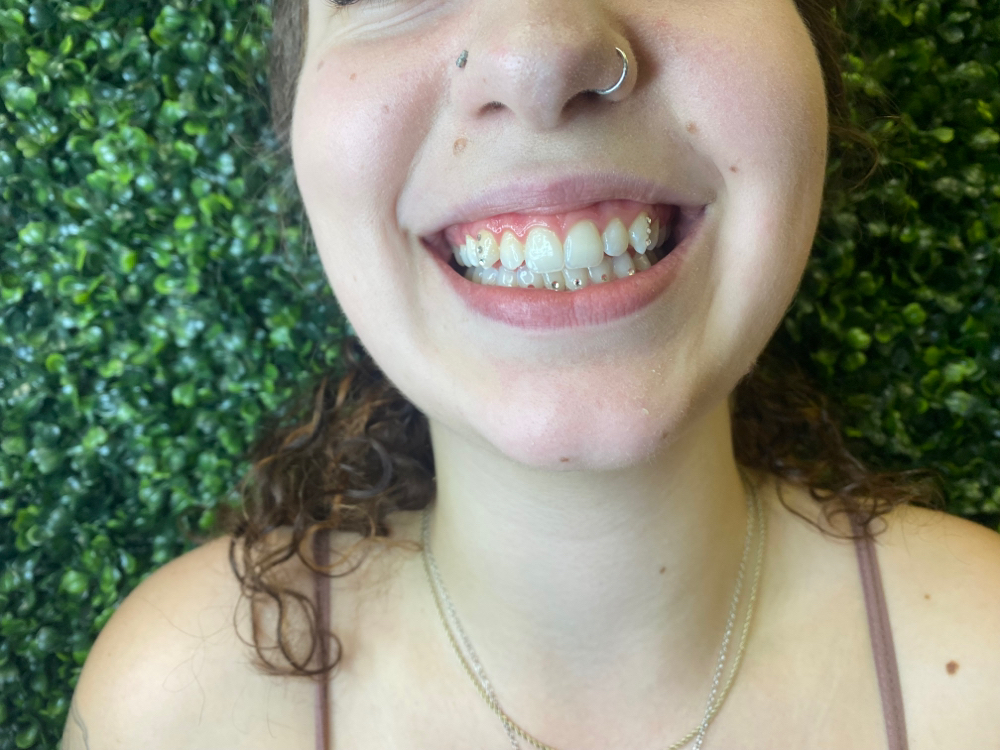 Tooth Gems