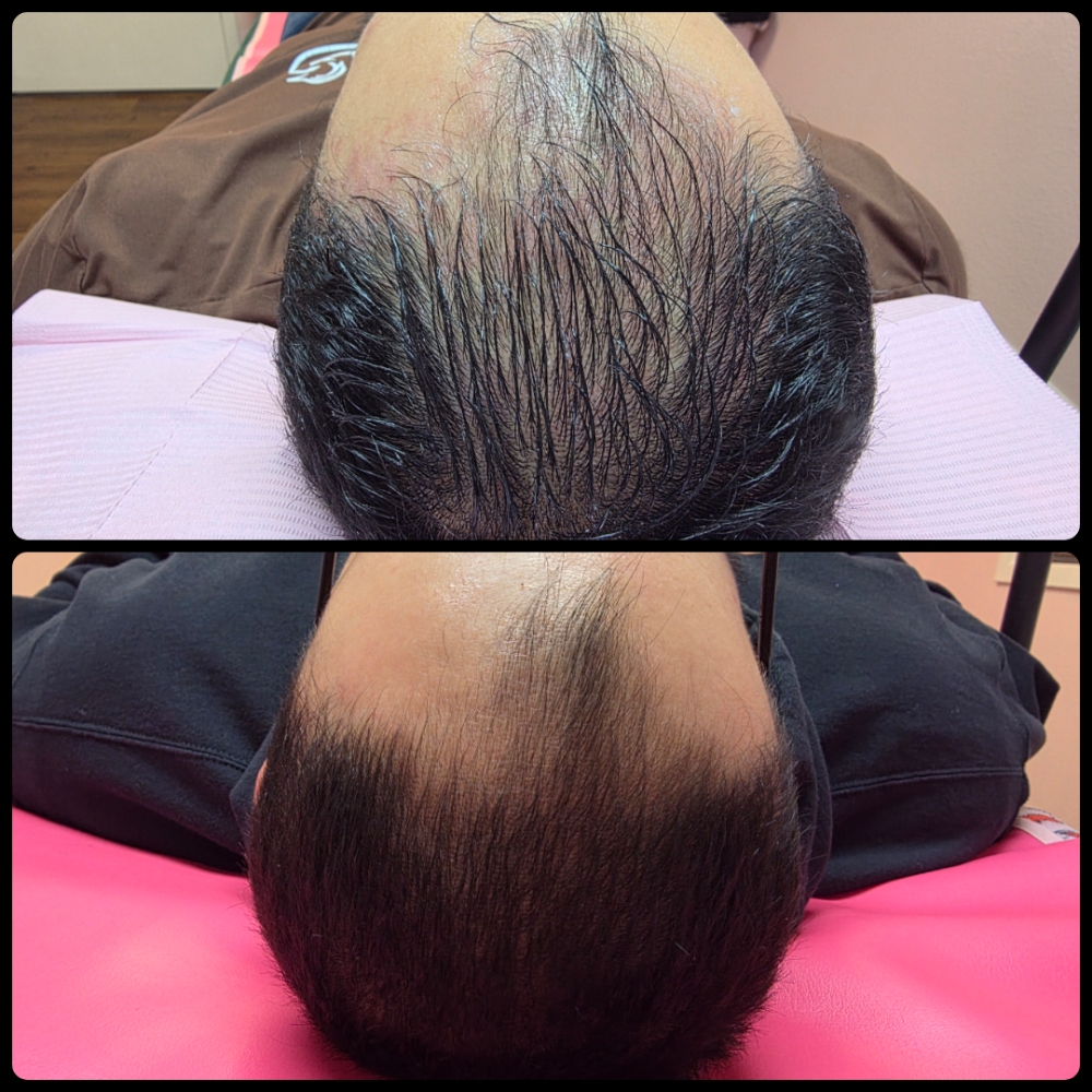 Hair Rejuvenation X EXOSOMES at Glass Face Aesthetics LLC in Fort Stockton, TX