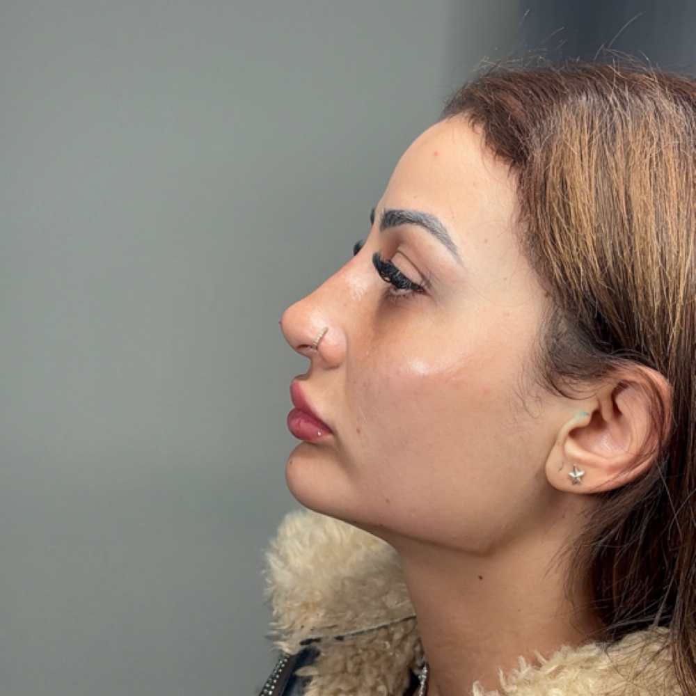 Liquid Rhinoplasty ( Nose ) at Opulence Beaute in Dunwoody Ga, GA