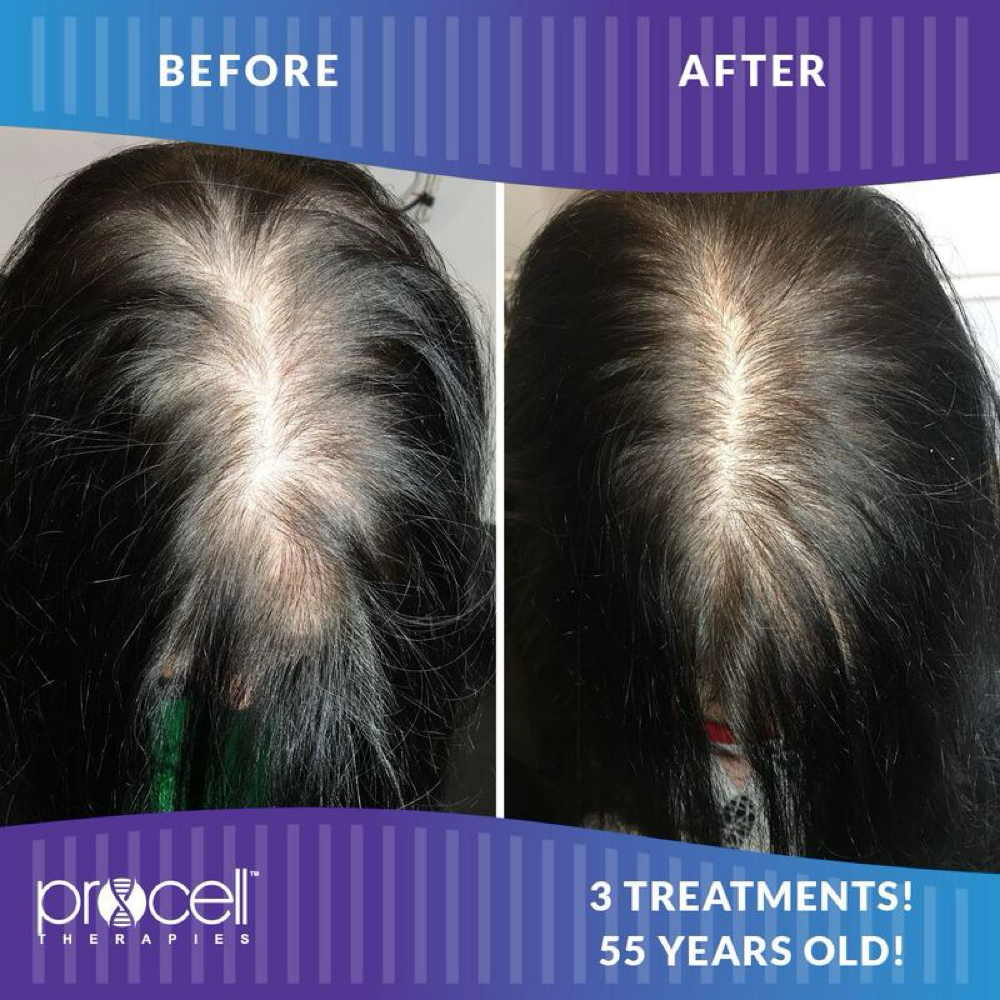 Hair Restoration *FIRST SESSION* at COLE SKIN STUDIO in Murfreesboro, TN
